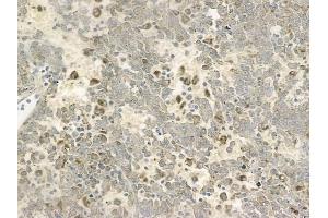 ABIN6257409 and ABIN6273693 at 1/100 staining human melanoma by IHC-P.