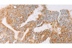 Immunohistochemistry of paraffin-embedded Human colon cancer tissue using YARS2 Polyclonal Antibody at dilution 1:30 (YARS2 抗体)