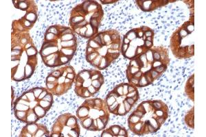 Formalin-fixed, paraffin-embedded human Colon Carcinoma stained with EpCAM Mouse Recombinant Monoclonal Antibody (rMOC-31). (Recombinant EpCAM 抗体)