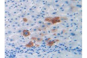 IHC-P analysis of Human Liver Cancer Tissue, with DAB staining. (Relaxin 2 抗体  (AA 1-186))
