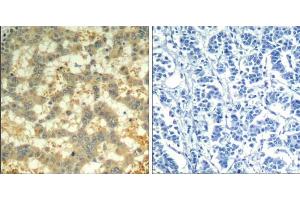 Immunohistochemical analysis of paraffin-embedded human breast carcinoma tissue using syk (phospho-Tyr323) Antibody (E011546). (SYK 抗体  (pTyr323))