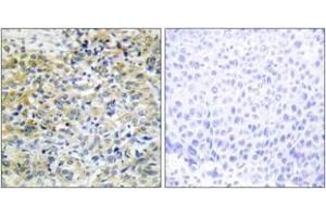 Immunohistochemistry analysis of paraffin-embedded human liver carcinoma tissue, using CARKL Antibody. (SHPK 抗体  (AA 31-80))