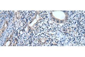 Immunohistochemistry of paraffin-embedded Human cervical cancer tissue using USP32 Polyclonal Antibody at dilution of 1:75(x200) (USP32 抗体)