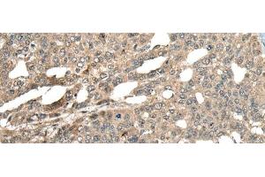 Immunohistochemistry of paraffin-embedded Human liver cancer tissue using MCPH1 Polyclonal Antibody at dilution of 1:110(x200) (MCPH1 抗体)
