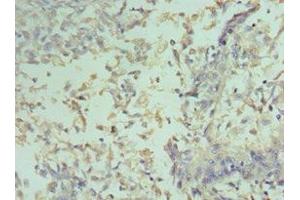 Immunohistochemistry of paraffin-embedded human cervical cancer using ABIN7153389 at dilution of 1:100 (Cyclin D2 抗体  (AA 1-289))
