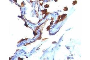Formalin-fixed, paraffin-embedded human lung carcinoma stained with Cytokeratin 8 + 18 antibody (C-51). (Cytokeratin 8/18 抗体)