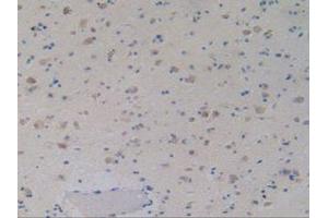 IHC-P analysis of Human Glioma Tissue, with DAB staining. (GDF2 抗体  (AA 32-427))