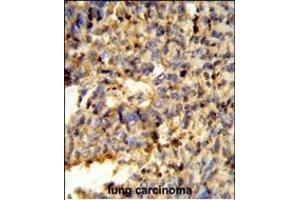 Formalin-fixed and paraffin-embedded human lung carcinoma reacted with FCGR2C Antibody (C-term), which was peroxidase-conjugated to the secondary antibody, followed by DAB staining. (FCGR2C 抗体  (C-Term))