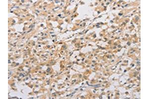 The image on the left is immunohistochemistry of paraffin-embedded Human thyroid cancer tissue using ABIN7128532(ARSF Antibody) at dilution 1/20, on the right is treated with fusion protein. (ARSF 抗体)