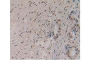 DAB staining on IHC-P; Samples: Human Pancreas Cancer Tissue. (MSTN 抗体  (AA 267-375))