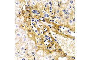 Immunohistochemistry of paraffin-embedded human liver injury using CFH antibody (ABIN5971193) at dilution of 1/200 (40x lens). (Complement Factor H 抗体)