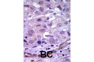 Formalin-fixed and paraffin-embedded human cancer tissue reacted with the primary antibody, which was peroxidase-conjugated to the secondary antibody, followed by AEC staining. (Ret Proto-Oncogene 抗体  (N-Term))