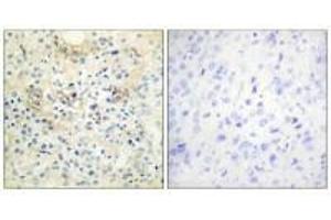 Immunohistochemistry analysis of paraffin-embedded human prostate carcinoma tissue, using TM16G antibody. (Anoctamin 7 抗体  (C-Term))