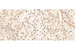 Immunohistochemistry of paraffin-embedded Human liver cancer tissue using MDFI Polyclonal Antibody at dilution of 1:55(x200) (MDFI 抗体)