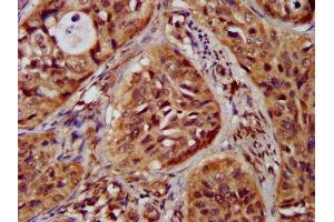 IHC image of ABIN7147960 diluted at 1:300 and staining in paraffin-embedded human cervical cancer performed on a Leica BondTM system. (ST3GAL4 抗体  (AA 39-184))