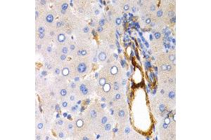 Immunohistochemistry of paraffin-embedded 人human liver cancer using TFF1 antibody at dilution of 1:200 (400x lens).