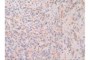 IHC-P analysis of Human Prostate Gland Cancer Tissue, with DAB staining. (Chordin 抗体  (AA 700-918))