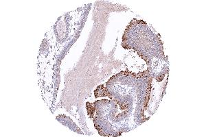 Gastric adenocarcinoma of the fundic gland type with distinct pepsinogen I staining of tumor cells (Recombinant Pepsinogen A 抗体)