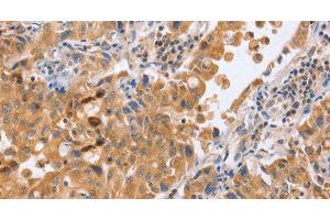 Immunohistochemistry of paraffin-embedded Human lung cancer tissue using BLNK Polyclonal Antibody at dilution 1:50 (B-Cell Linker 抗体)