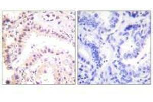 Immunohistochemical analysis of paraffin-embedded human lung carcinoma tissue using Cullin 2 antibody. (Cullin 2 抗体)