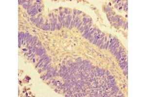 Immunohistochemistry of paraffin-embedded human ovarian cancer using ABIN7148641 at dilution of 1:100 (NR2F2 抗体  (AA 123-383))