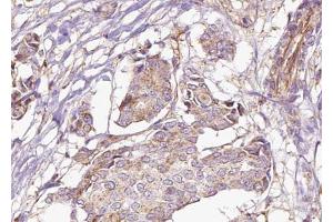 ABIN6273030 at 1/100 staining Human breast cancer tissue by IHC-P. (AFG3L2 抗体  (C-Term))