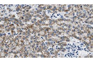 ABIN6275386 at 1/100 staining Human liver cancer tissue by IHC-P. (KCNQ4 抗体  (C-Term))