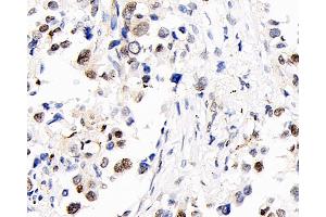 Immunohistochemistry analysis of paraffin-embedded human lung cancer using S100A4 Polyclonal Antibody at dilution of 1:400. (s100a4 抗体)