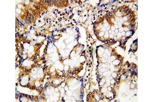 IHC-P: Caspase-10 antibody testing of human intestinal cancer  tissue (Caspase 10 抗体  (AA 220-236))