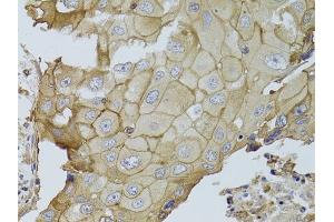 Immunohistochemistry of paraffin-embedded human breast cancer using GGT1 antibody (ABIN3022526, ABIN3022527, ABIN3022528 and ABIN6218881) at dilution of 1:100 (40x lens). (GGT1 抗体  (AA 370-569))