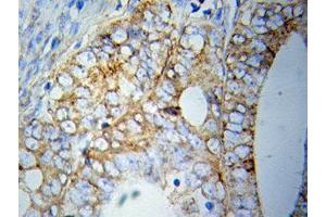 Immunohistochemistry of paraffin-embedded Prostate cancer using HSPA5 antibody. (GRP78 抗体  (AA 550-650))
