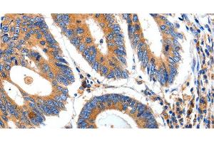 Immunohistochemistry of paraffin-embedded Human colon cancer tissue using IGFBP7 Polyclonal Antibody at dilution 1:50 (IGFBP7 抗体)