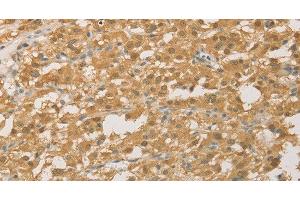 Immunohistochemistry of paraffin-embedded Human thyroid cancer using PGK2 Polyclonal Antibody at dilution of 1:50 (PGK2 抗体)