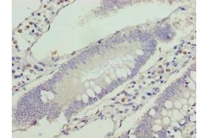 Immunohistochemistry of paraffin-embedded human colon cancer using ABIN7175336 at dilution of 1:100 (VPS25 抗体  (AA 1-176))
