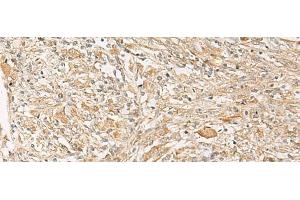 Immunohistochemistry of paraffin-embedded Human liver cancer tissue using GPR22 Polyclonal Antibody at dilution of 1:50(x200) (GPR22 抗体)