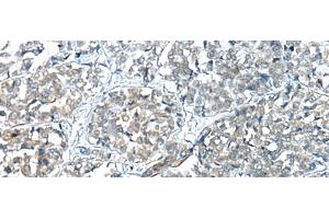 Immunohistochemistry of paraffin-embedded Human esophagus cancer tissue using COMMD6 Polyclonal Antibody at dilution of 1:45(x200) (COMMD6 抗体)