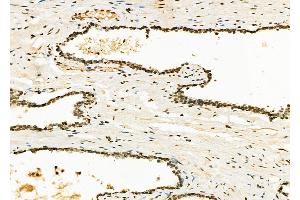 ABIN6262249 and ABIN6273123 at 1/100 staining Human liver cancer by IHC-P.