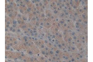 DAB staining on IHC-P; Samples: Human Liver cancer Tissue (TAB1 抗体  (AA 189-439))