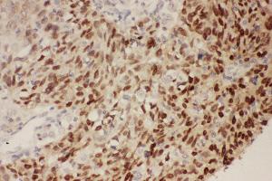 Immunohistochemistry (IHC) image for anti-Tumor Protein P53 (TP53) (AA 74-393) antibody (ABIN3042524)