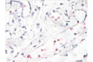 Immunostaining of human breast cancer tissue showing p38 when phosphorylated at Thr180/Tyr182 in red. (MAPK14 抗体  (pThr180, pTyr182))