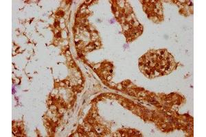 IHC image of ABIN7166095 diluted at 1:364 and staining in paraffin-embedded human prostate cancer performed on a Leica BondTM system. (SAV1 抗体  (AA 1-210))