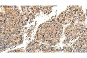 Immunohistochemistry of paraffin-embedded Human liver cancer tissue using SLC27A1 Polyclonal Antibody at dilution 1:40 (SLC27A1 抗体)