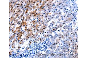 Immunohistochemistry of Human liver cancer using IL2RA Polyclonal Antibody at dilution of 1:30 (CD25 抗体)
