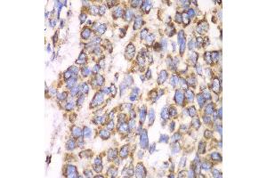Immunohistochemistry of paraffin-embedded human esophageal cancer using ATP5A1 antibody at dilution of 1:100 (x40 lens). (ATP5A1 抗体)