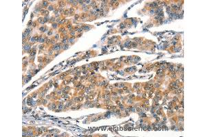 Immunohistochemistry of Human breast cancer using STK17A  Polyclonal Antibody at dilution of 1:25 (STK17A 抗体)