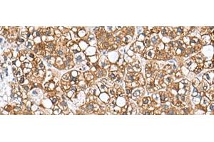 Immunohistochemistry of paraffin-embedded Human liver cancer tissue using PHLDA3 Polyclonal Antibody at dilution of 1:110(x200) (PHLDA3 抗体)