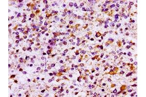 IHC image of ABIN7156768 diluted at 1:100 and staining in paraffin-embedded human glioma performed on a Leica BondTM system. (IL1R2 抗体  (AA 79-219))
