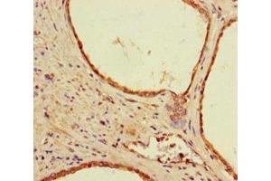 Immunohistochemistry of paraffin-embedded human prostate cancer using ABIN7142194 at dilution of 1:100 (26S Proteasome Complex Subunit SEM1 (SEM1) (AA 1-70) 抗体)