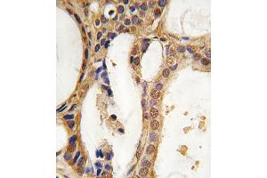 Formalin-fixed and paraffin-embedded human prostata carcinoma tissue reacted with PIM1 antibody, which was peroxidase-conjugated to the secondary antibody, followed by DAB staining. (PIM1 抗体)