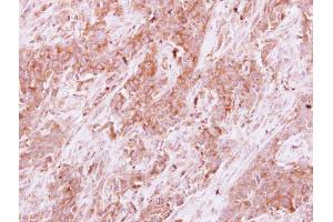 IHC-P Image Homer3 antibody detects Homer3 protein at cytoplasm on human Papillary adenocarcinoma by immunohistochemical analysis. (HOMER3 抗体  (Center))